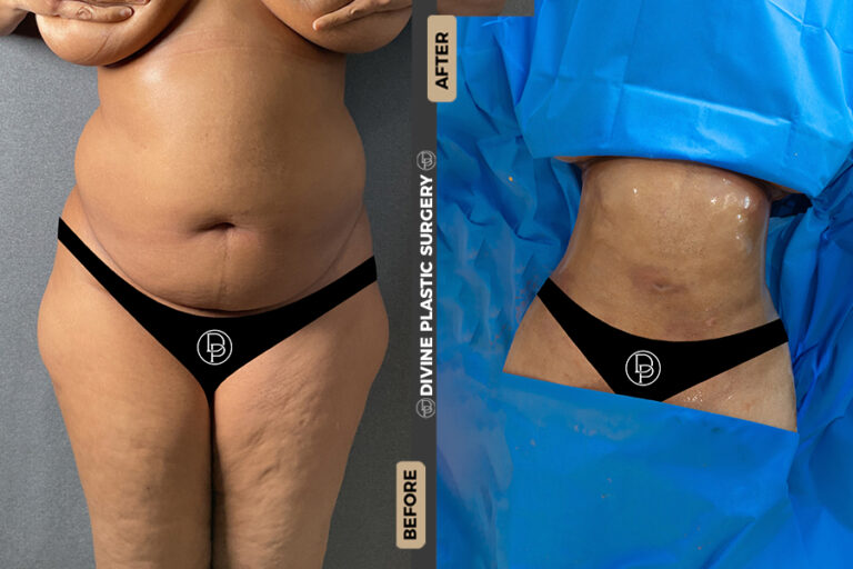tummy tuck 360