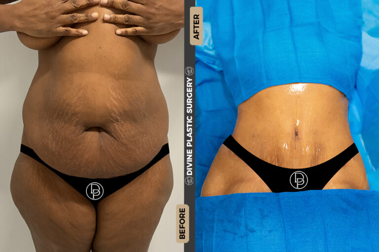 abdominoplasty