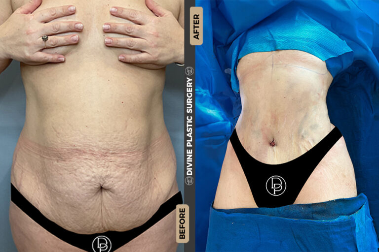 tummy tuck