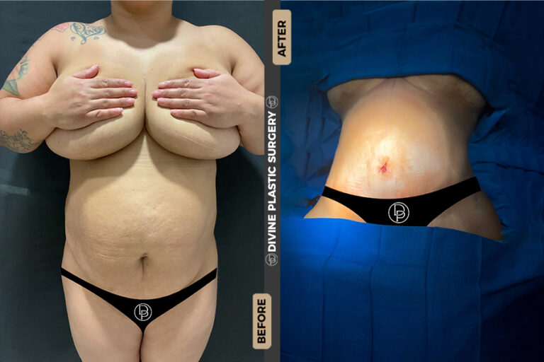 plus size tummy tuck