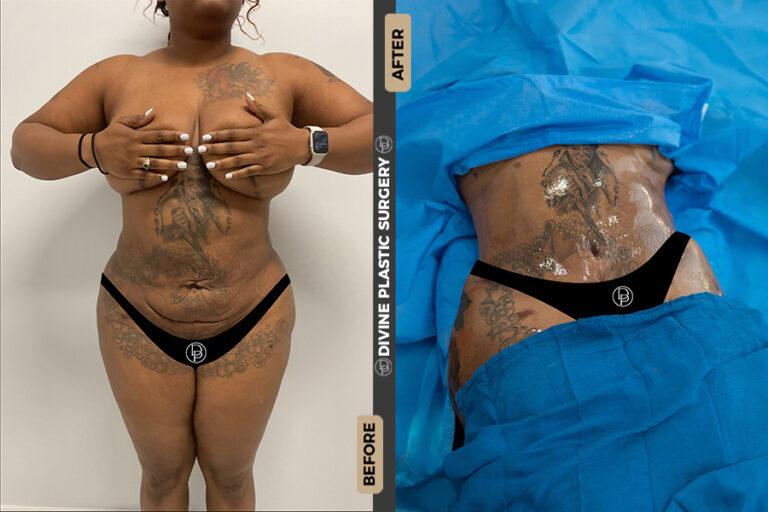 Miami tummy tuck