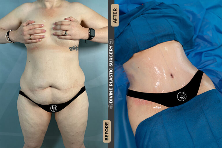 tummy tuck surgery
