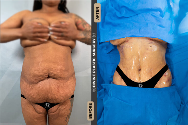 tummy tuck