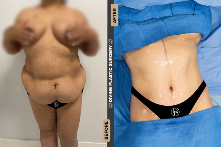 abdominoplastia