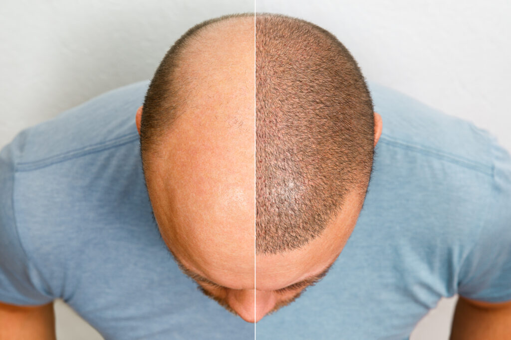 hair implant