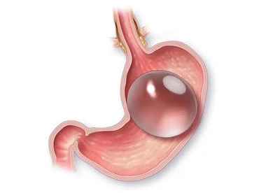 Gastric Balloon