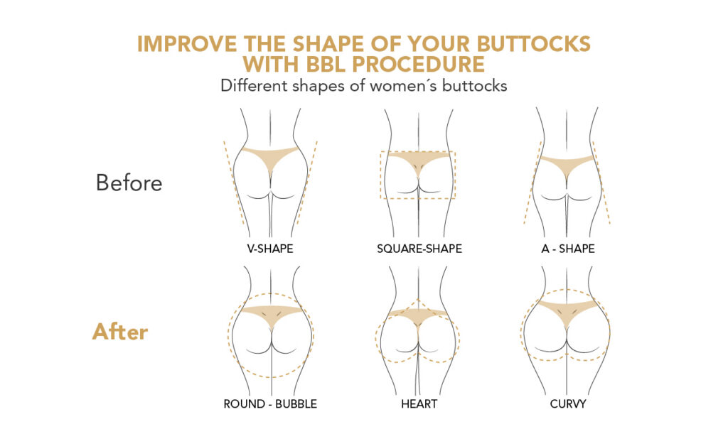 brazilian-butt-lift-miami