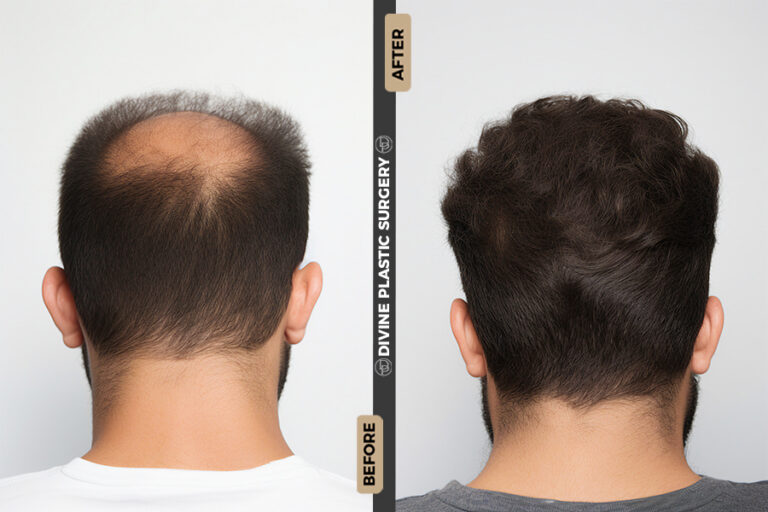 BA HAIR3