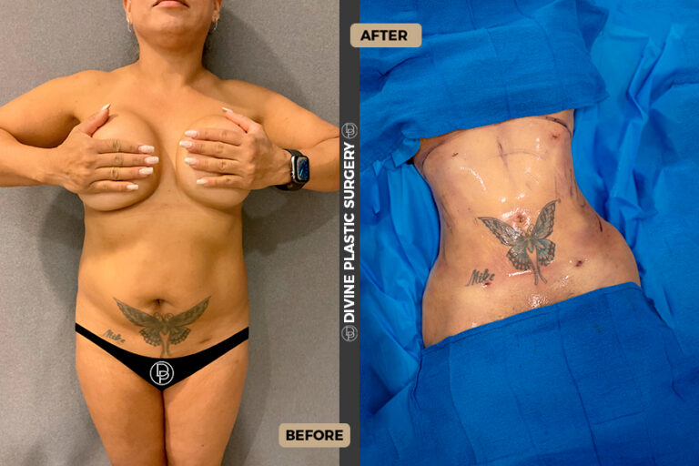 BA LIPO10