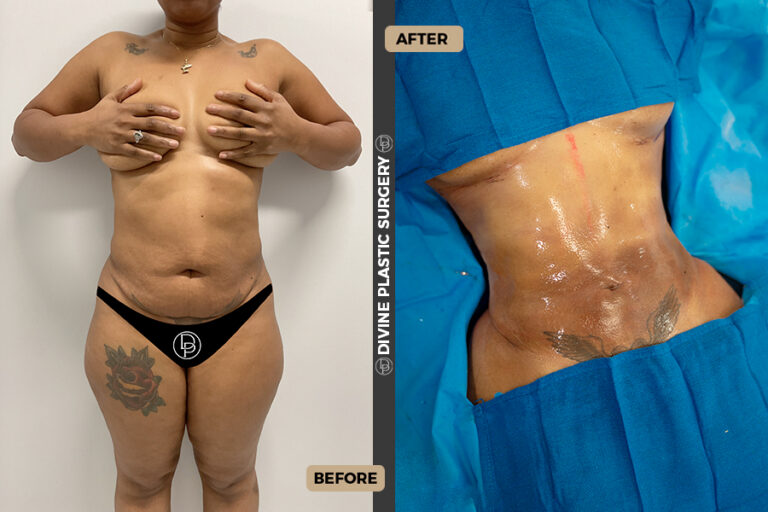 BA LIPO12
