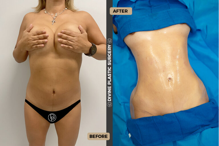 BA LIPO13