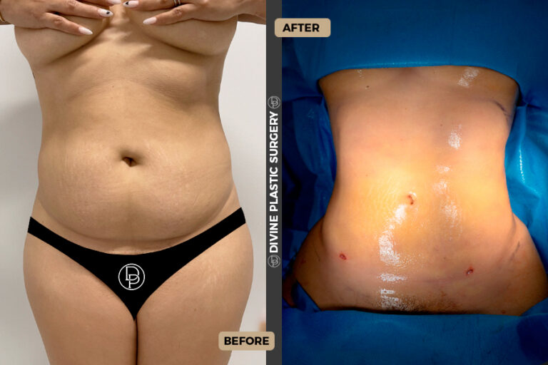 BA LIPO3
