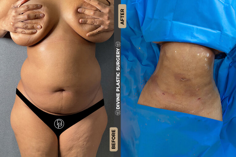 BA LIPO31