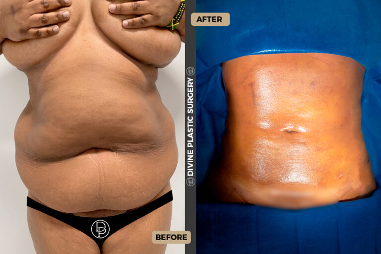 BA LIPO4