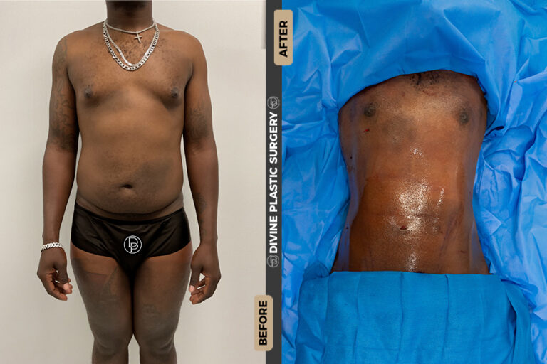 BA LIPO42