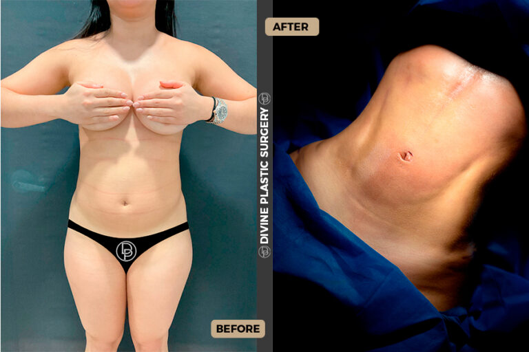 BA LIPO9