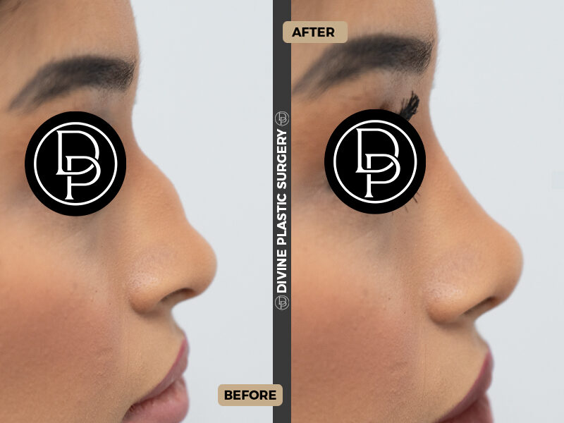 rhinoplasty in Miami