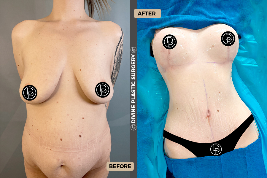 mommy makeover miami