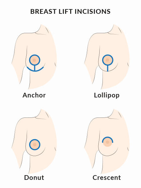 breast-lift-miami