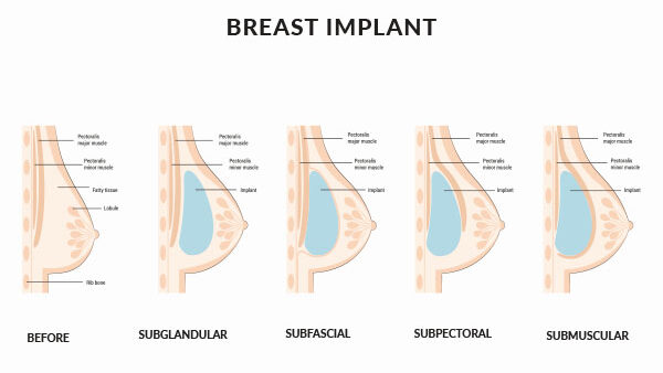 breast-augmentation-miami