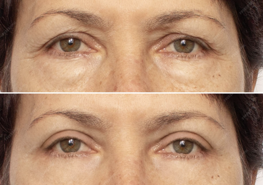 blepharoplasty-miami-before-and-after