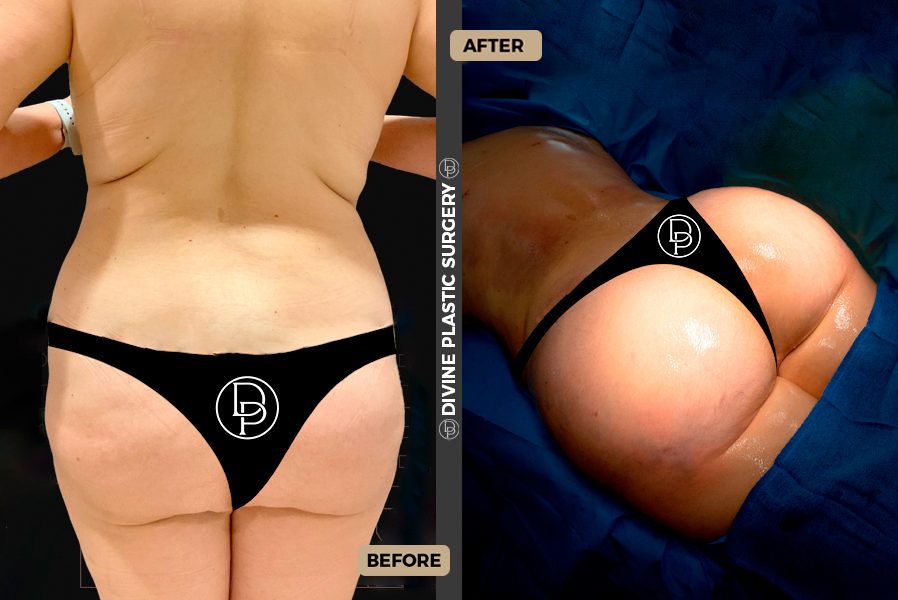 TUMMY TUCK BEFORE AND AFTER - Miami Lakes Plastic Surgery