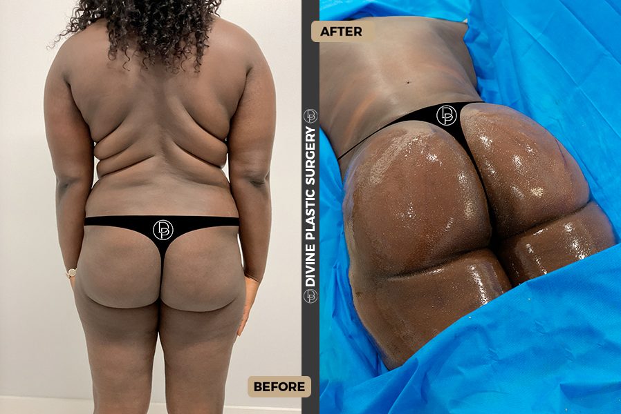 TUMMY TUCK BEFORE AND AFTER - Miami Lakes Plastic Surgery