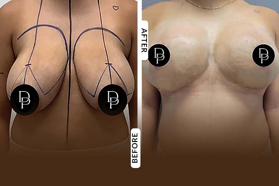 Breast Reduction Divine Plastic Surgery